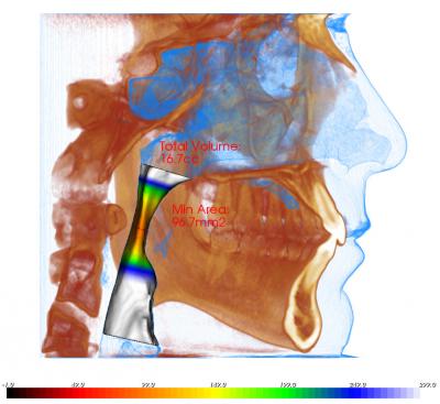 3D Airway Analysis for Sleep Apnea